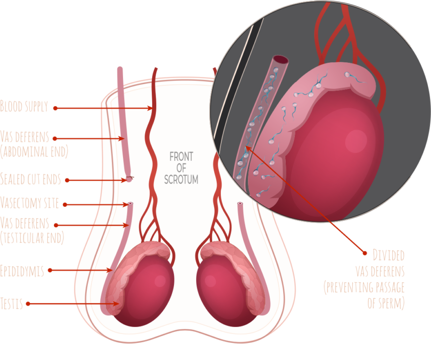 Vasectomy Clinic In Portland Or